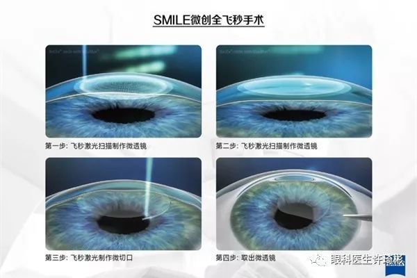 什么是全飞秒激光手术?什么是SMILE手术?