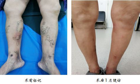 静脉炎治疗：探索高效疗法