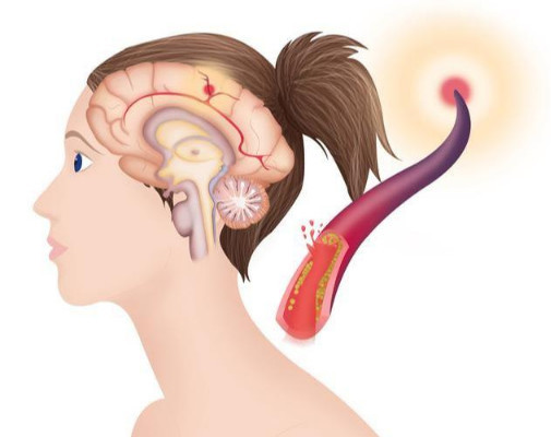 医生:发现颈动脉斑块别慌张,了解这些知识很重