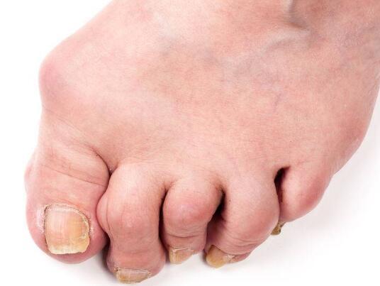 糖尿病足若出现5种病症 要及早发现 不用烂脚截肢 要把握住 腾讯网