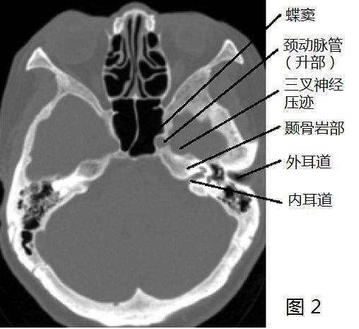 一文带你学会颈内动脉的走形