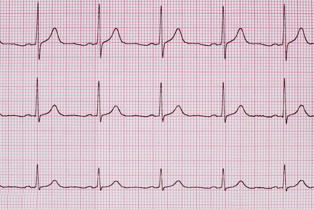 窦性心律是啥意思?窦性心律不齐是不是心脏病?医生告诉您答案