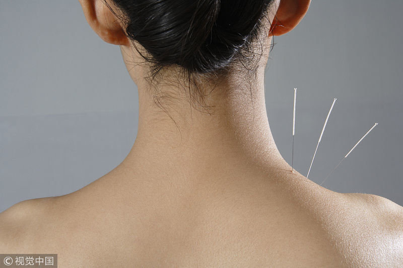 针刺疗法应结合局部穴位和经络穴位.
