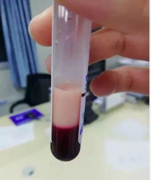 小伙暴肥90多斤,还抽出"猪油血"……|奶茶|乳糜血|胰腺炎|糖尿病|急性