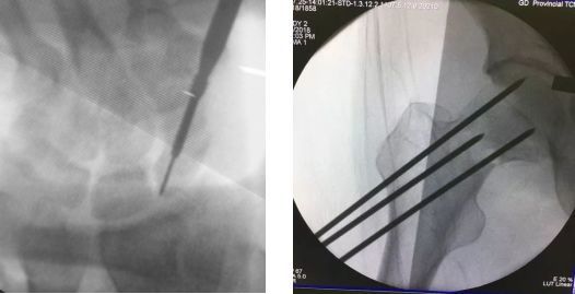 克氏针的n 种神奇用法 腾讯新闻