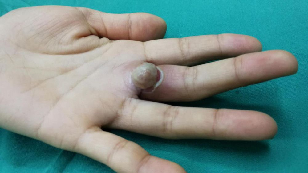 益阳一女子手掌长出肿块几天就从绿豆变成花生大