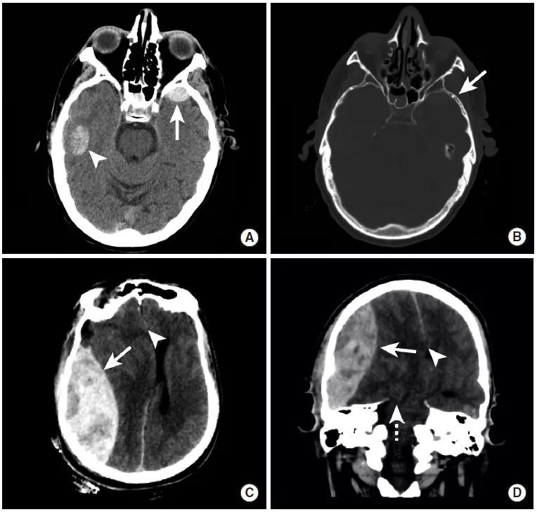 圖b:mri flair序列同樣可見腦溝內高信號,證實了蛛網膜下腔出血的存在