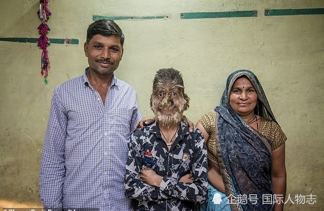 男孩患罕见多毛症脸上都是毛 称长大了想当警察保护父母 警察 印度 社会