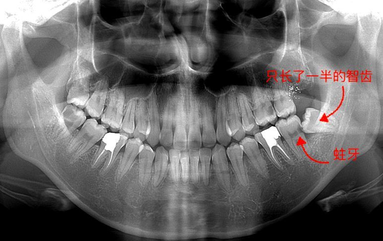 智齿不痛就不用拔吗?看了这篇你就懂了
