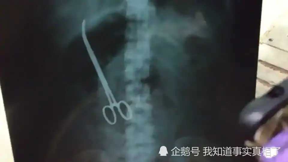 女子肚子疼痛三个月 医生竟从她体内找到一把手术钳