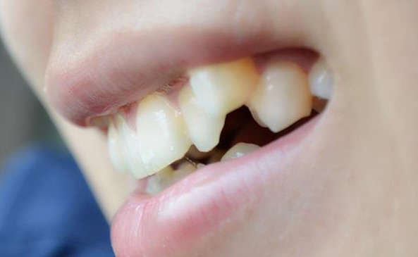 牙齿上的黄泥是什么?如何才能去除?