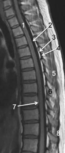 圖 6 胸椎 t1wi 序列成像:1,胸髓;2,蛛網膜下腔;3,硬膜外脂肪;4,黃