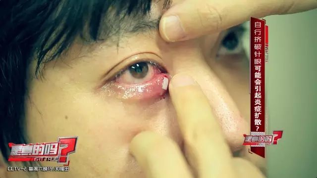 眼睛长这种小东西千万别乱挤严重可致失明