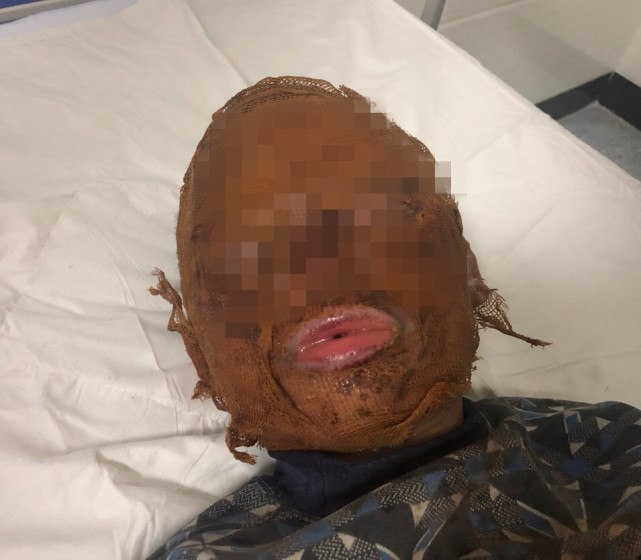 郴州8岁男童捡拾废弃鞭炮 自制花炮面部被严重炸伤