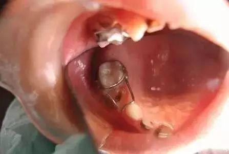 解决办法:预防为主,教育孩子爱护自己的牙齿,并通过安全教育减少外伤.