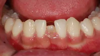 漂亮女童长出"双排牙"吓坏同学,若不注意这个行为,发病率高达30%