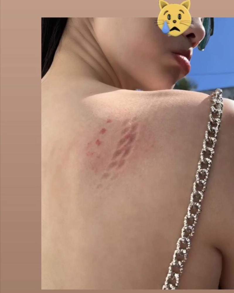 事业双丰收,准备嫁入豪门,今天(21号)奚梦瑶还晒出了自己后背伤痕照片