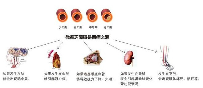 糖尿病并发症|突破性科研成果，疏通微循环障碍，逆转糖尿病并发症