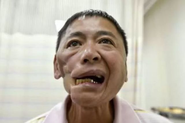 不同于其他癌症,口腔癌一旦病发,治疗过程及其痛苦,被切脸刨肉的创伤