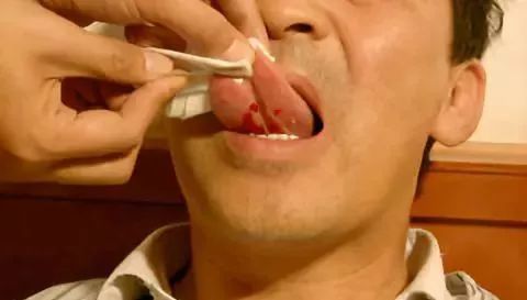 世界艾乡资讯-醒脑三针,调理中风-艾灸资讯-世界艾乡官方网站