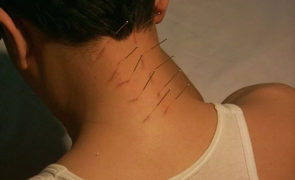 世界艾乡资讯-醒脑三针,调理中风-艾灸资讯-世界艾乡官方网站