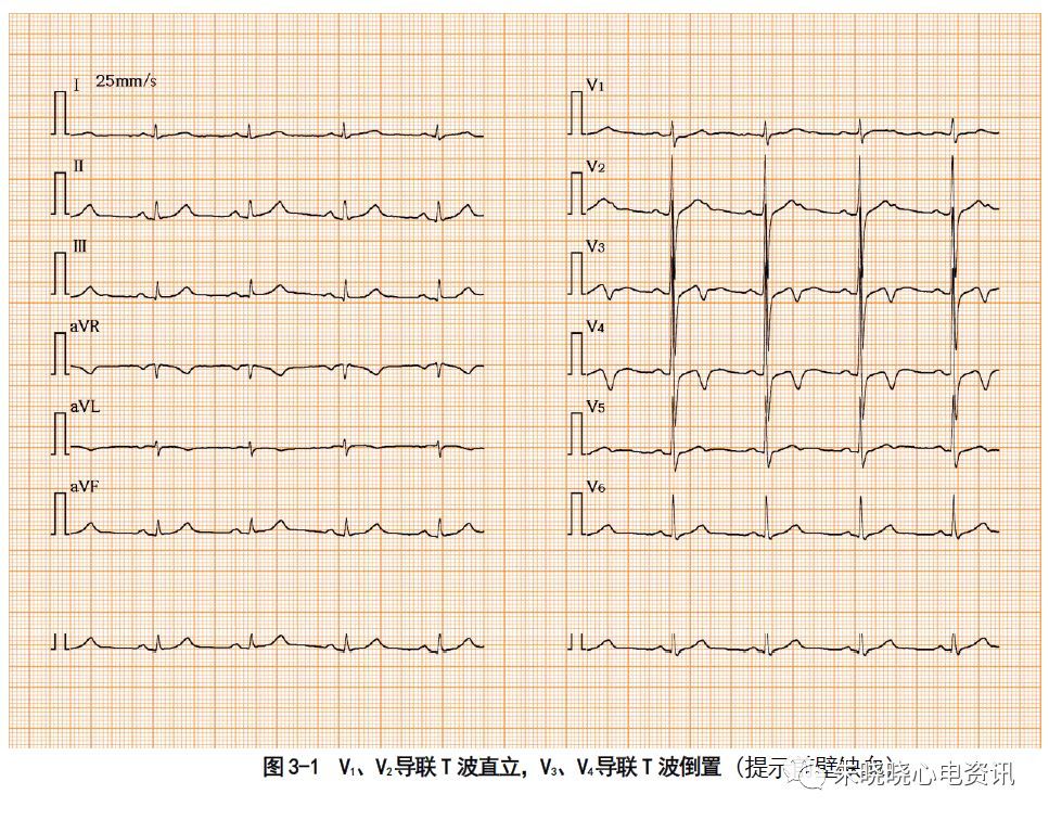 心电系列第三讲stt改变的临床意义