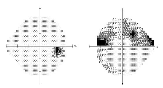 視力正常與早期青光眼患者的視野圖
