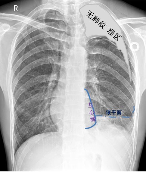 气胸的x线表现6个病例帮你搞定