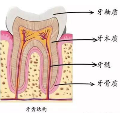 中齲:蛀牙發展到中期,也就是細菌破壞牙釉質攻到「牙本質」,這種情況