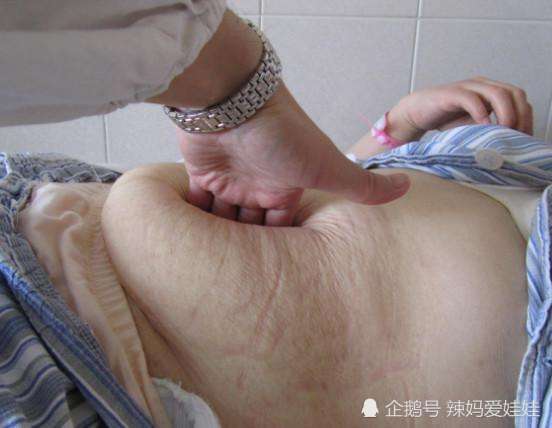 生完宝宝的产妇肚子,看完让人心疼|宝宝|妊娠纹|产妇