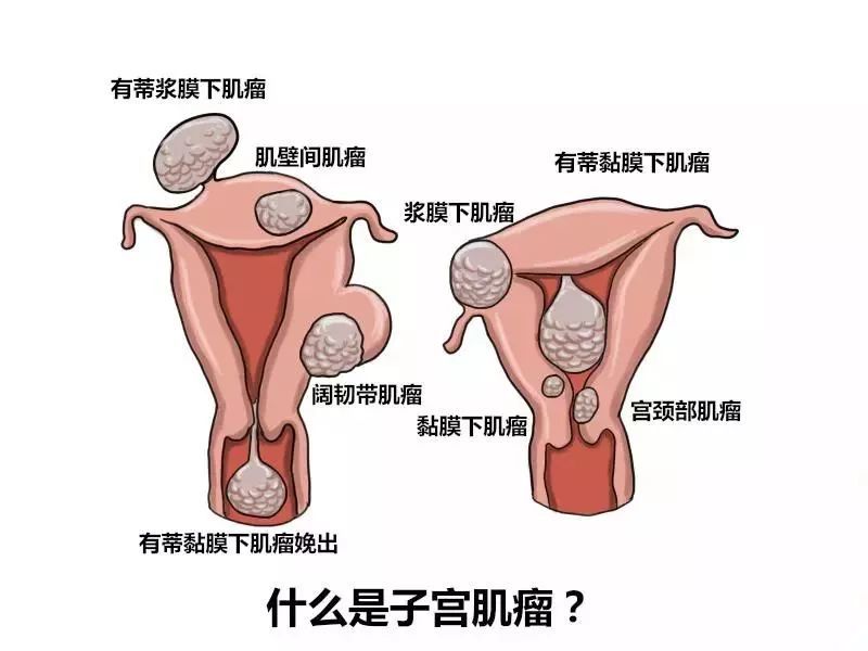 面对子宫肌瘤我该怎么办
