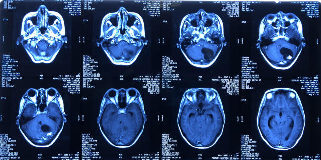 术前头部核磁共振(mri)