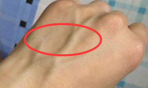 不论男女,手上长出"这玩意",八成"癌症"已靠近,希望你没有