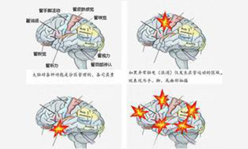 引起癫痫发作的原因都有哪些？