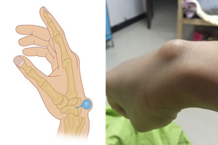 右手腕腱鞘囊肿怎么办 详述常见的肿块治疗方法