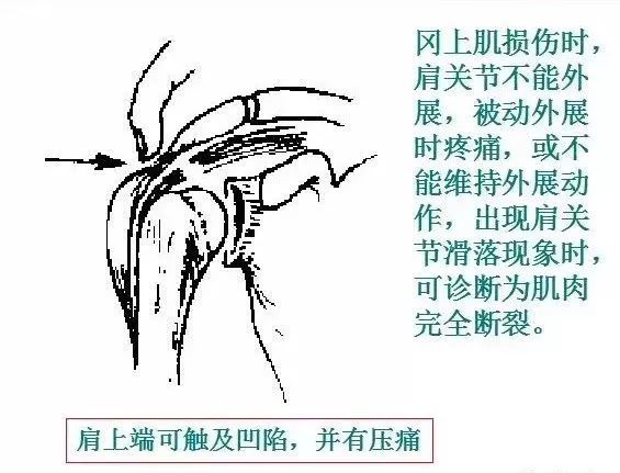 尺神經損傷11.正中神經損傷12.屈拇握拳尺偏試驗5膝部損傷檢查法1.