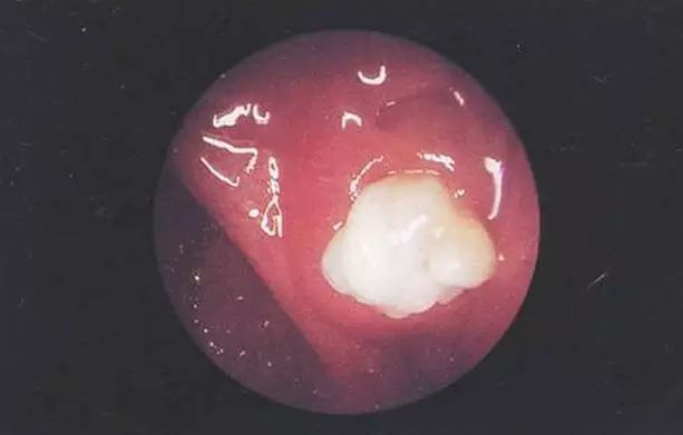 30岁男子,咳出黄白色"异物",捏碎后,臭气熏天,这是怎么了