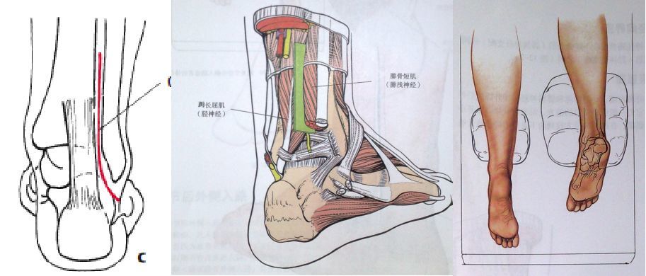 【骨科小技巧】踝关节骨折的手术入路!