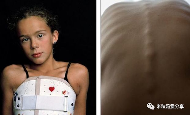 米粒妈赶紧去外网搜了搜,发现,还真是有不少孩子脊柱侧弯的,国外一个