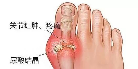 痛风有多痛?53岁男子被活活疼死!这些食物一定要忌口_腾讯新闻