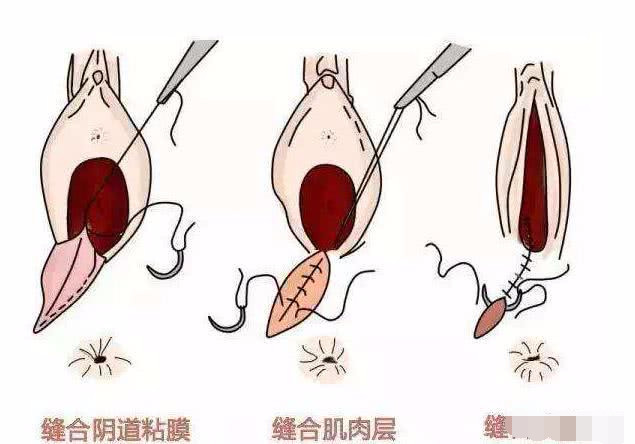 顺产侧切能有多痛呢?侧切和撕裂有什么区别?真相让人不敢相信