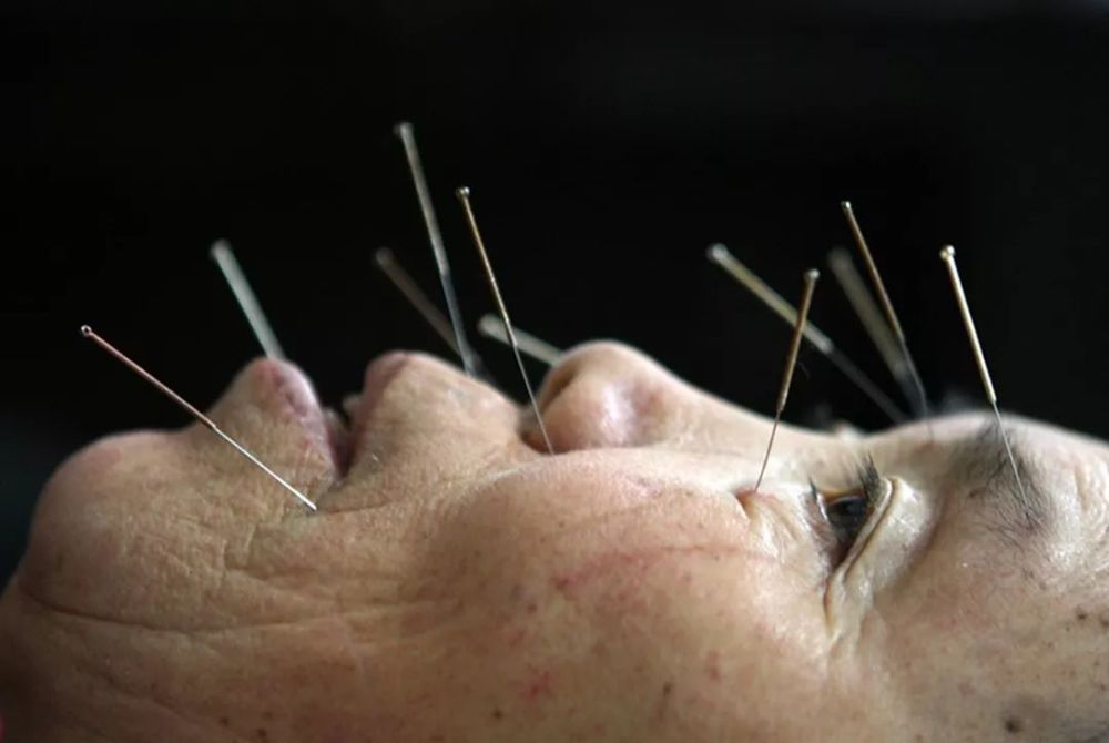 病人在接受艾灸疗法;病人正在用针治疗面部麻木