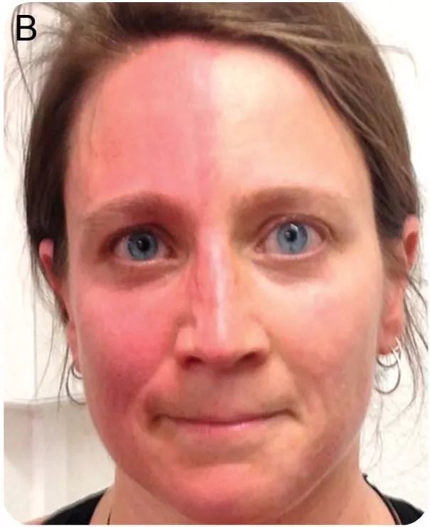 蝌蚪状瞳孔,"阴阳脸",咀嚼性疼痛……因何导致?_腾讯新闻