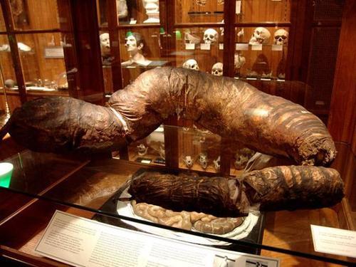 美国男子患巨肠症被大便憋死,其肠子重达50榜,被博物馆收藏!