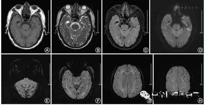 頭顱mri平掃 dwi示: (1)雙側半卵圓中心,雙側側腦室旁多發缺血梗死灶