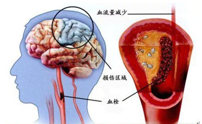 為什麼現在腦梗的人越來越多