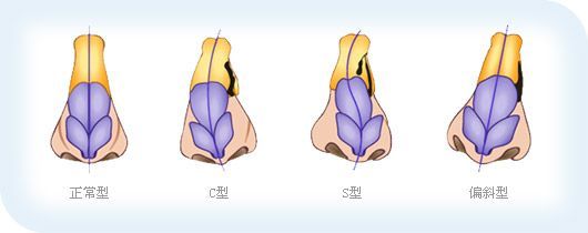 这么严重的鼻畸形,竟用自体肋软骨修好了!