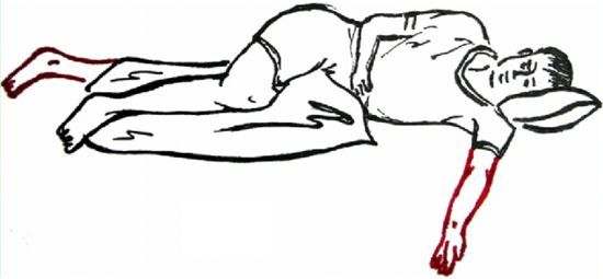 护理 要走出偏瘫患者不可患侧卧位的误区