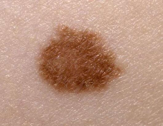 癌症也有前兆 4种小凸起 可能是癌已近在眼前的标志 要重视 老资料网