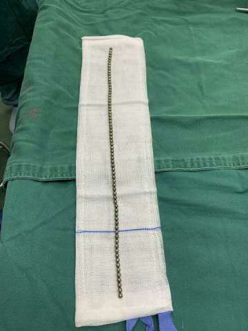 11岁年还把70颗钢珠塞进尿道中,看着都疼,网友:是个狼人!